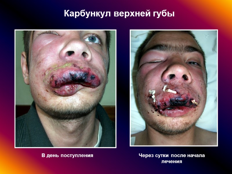 Карбункул верхней губы В день поступления Через сутки после начала лечения